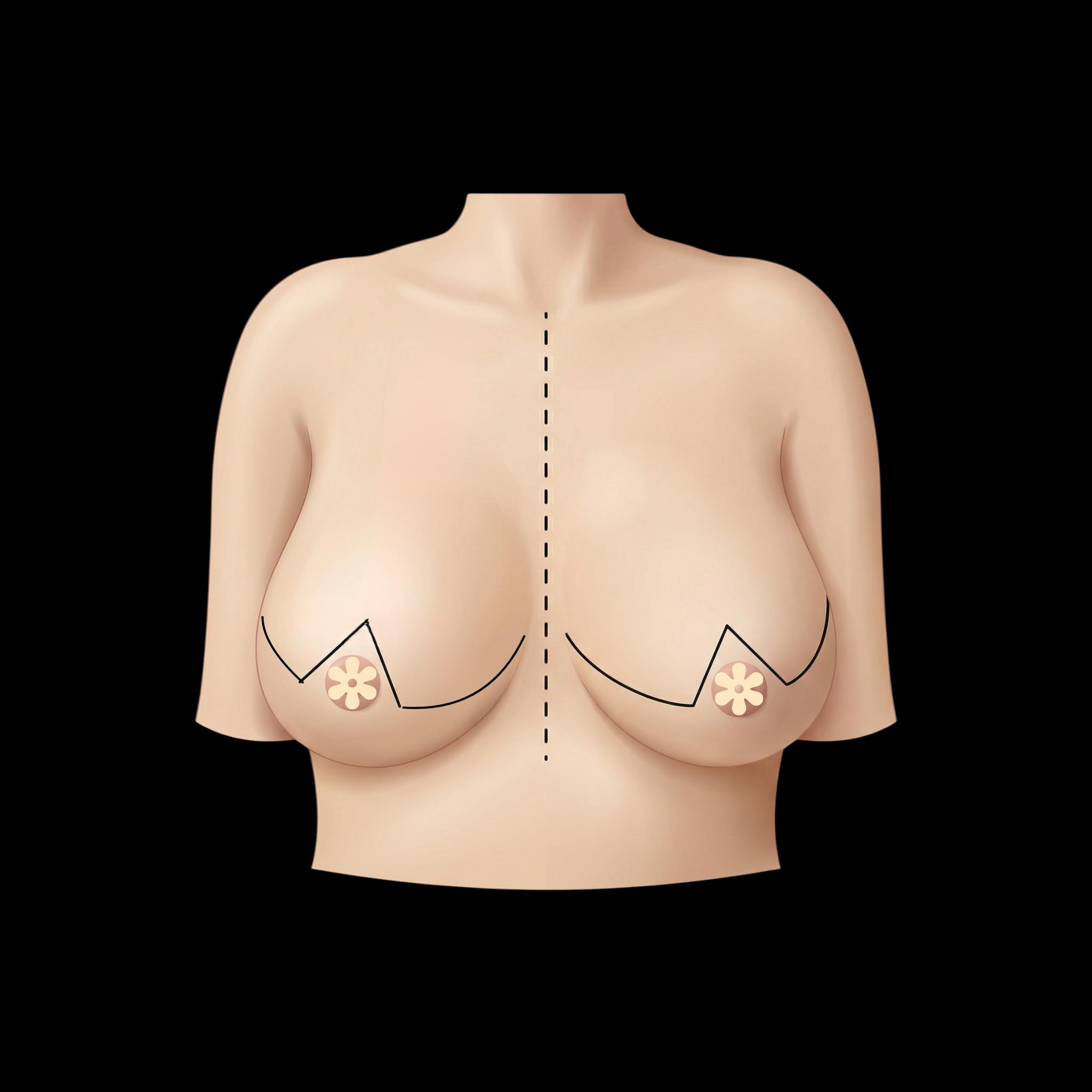 Breast Reduction (Reduction Mammoplasty) — plastic surgery procedure