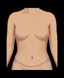 Tummy Tuck (Abdominoplasty) — plastic surgery procedure